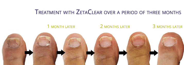 before and after zetaclear